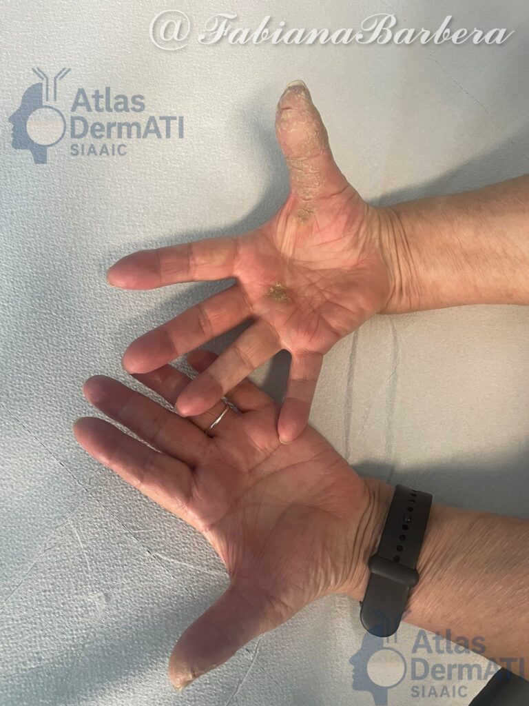 Eczema cronico delle mani