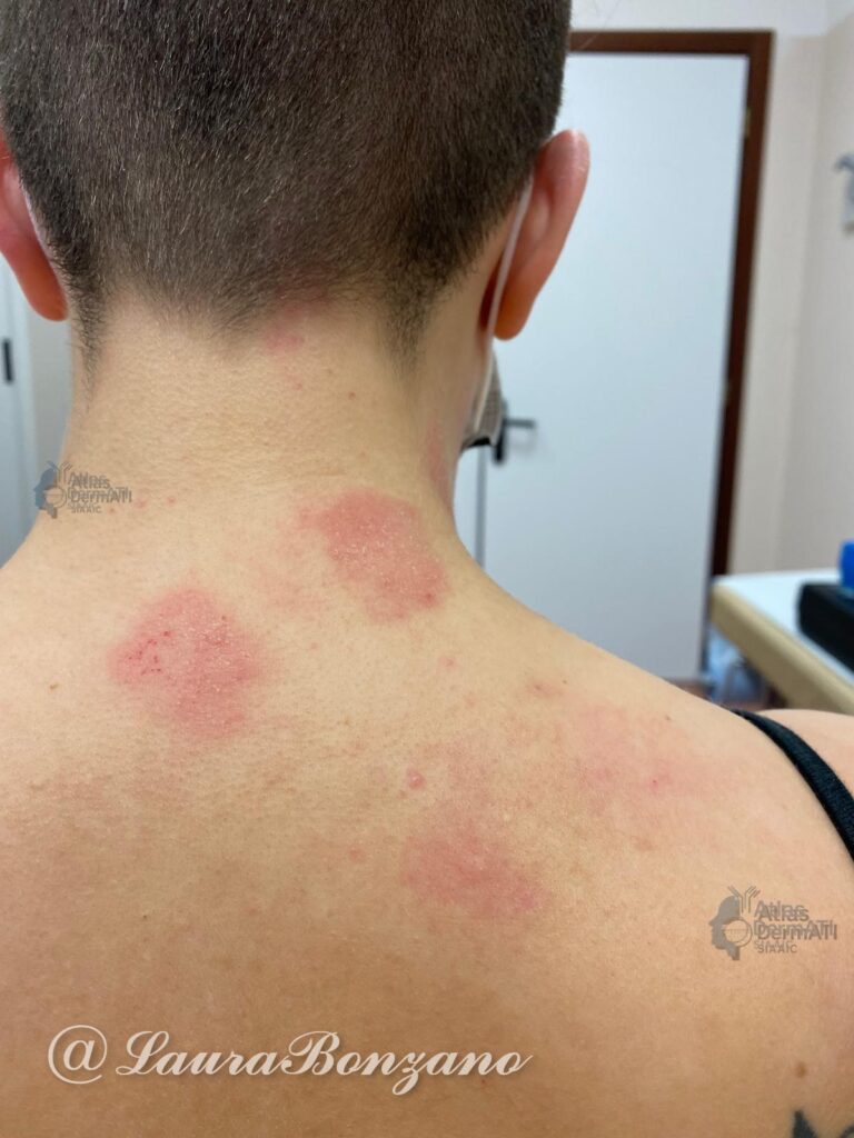Dermatite atopica con Lesioni eczematose nummulari.