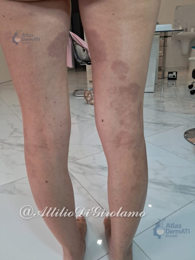 Granuloma anulare