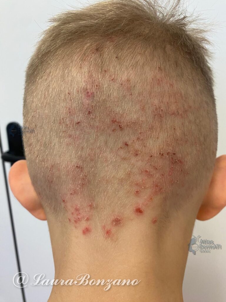 Dermatite atopica del capo