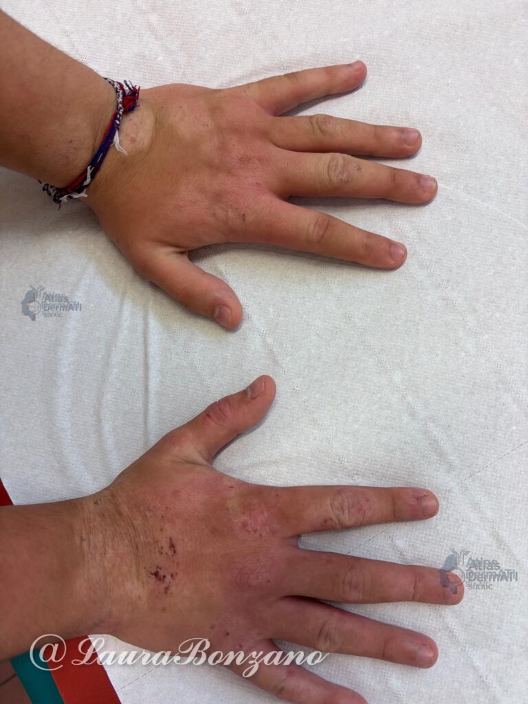 Eczema delle mani in Dermatite atopica