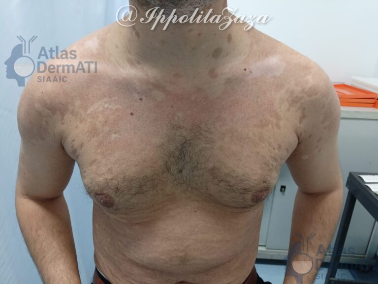 Morfea e Vitiligine