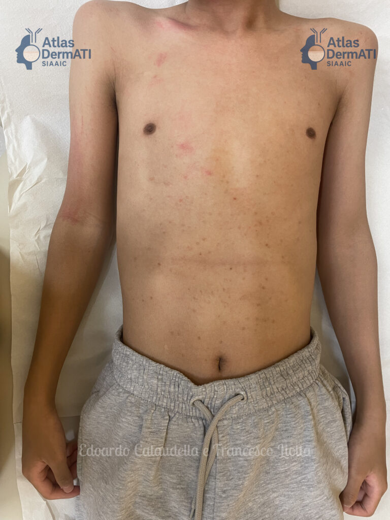 Mastocitosi Cutanea