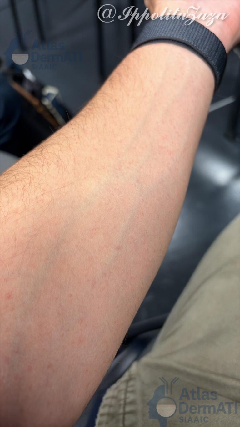 Orticaria colinergica