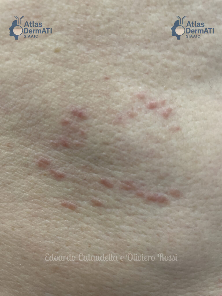 Papula in Granuloma Anulare