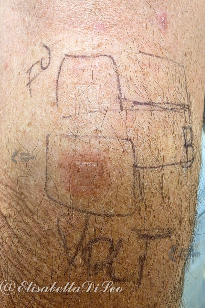 Patch test positivo a Diclofenac gel
