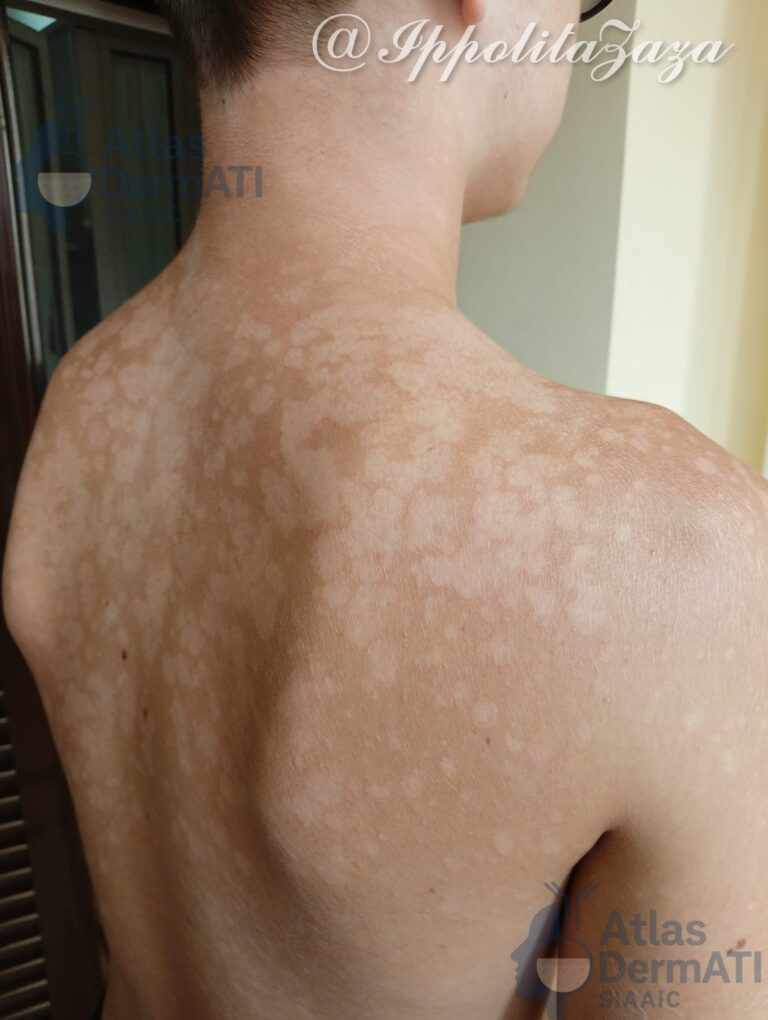 Pityriasis versicolor