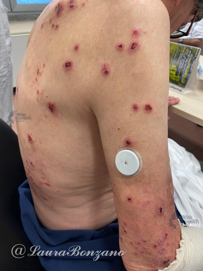 Prurigo nodularis.