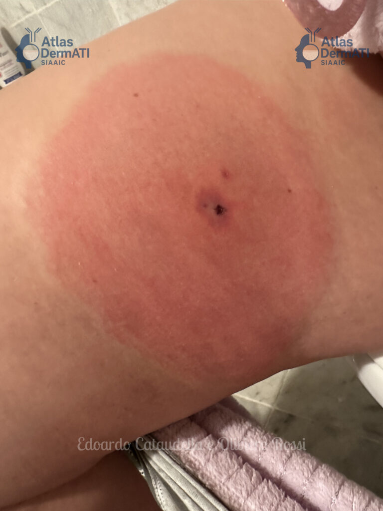 Ulcera + Placca in morso di ragno violino