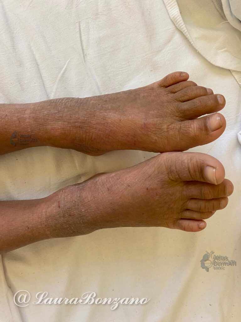 Dermatite atopica con intensa xerosi cutanea diffusa.