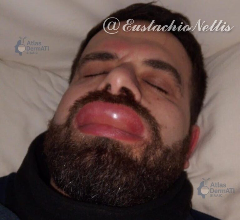 Angioedema da FANS